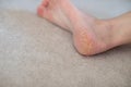 Close up cracked heels. Health problems with skin on feet Royalty Free Stock Photo