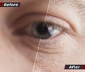 Technological concept, one hundred percent recovery of vision. Contact lenses. Good vision. Before and after.