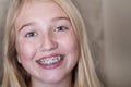 Teen girl with braces on her teeth Royalty Free Stock Photo