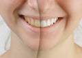 Teen girl smile before and after teeth whitening