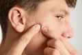 Teen guy with acne problem squeezing pimple on his face on light background