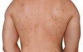 Teenage acne. Young guy with problem skin on broad back: red spots and pimples. Concept: allergies and rash from drugs, junk fat