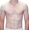 Teenage Boy Extreme Upper Body Acne Problem