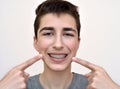 Teenage boy with braces on his teeth Royalty Free Stock Photo