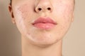 Teenage girl with acne problem on background, closeup Royalty Free Stock Photo