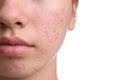 Teenage girl with acne problem on white background Royalty Free Stock Photo