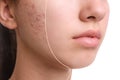 Teenage girl before and after acne treatment on background, closeup