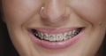 Teeth alignment by braces. Close up of female friendly smile. Dental care, orthodontic treatment. Correction of overbite