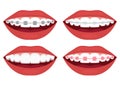 teeth alignment. Metal, ceramic, plastic, ligature and invisible braces Royalty Free Stock Photo