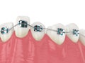 Teeth alignment by orthodontic braces isolated over white background