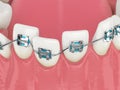 Teeth alignment by orthodontic braces isolated over white background