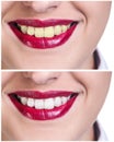Teeth before and after bleaching treatment Royalty Free Stock Photo