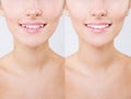Before and after teeth bleaching or whitening treatment. Close-up of young Caucasian female`s smile. Natural make- Royalty Free Stock Photo