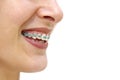 Teeth Braces