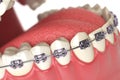 Teeth with braces or brackets in open human mouth. Dental care c