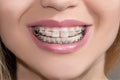 Teeth with braces Royalty Free Stock Photo