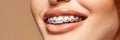 Teeth with braces, close up, suitable for dental treatment concept and orthodontic care advertising. Royalty Free Stock Photo