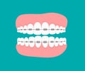 Teeth with braces.Flat vector illustration. Jaws isolated. orthodontic treatment braces on teeth. Dentistry and Orthodontics