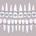 Teeth with braces