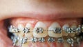 Teeth with braces or braces in an open human mouth. Selective focus on individual braces. Dental assistance. Straightened teeth.