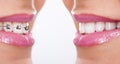 Teeth with braces Royalty Free Stock Photo