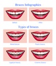 Teeth Braces Types Realistic Infographics