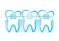 Teeth braces Royalty Free Stock Photo