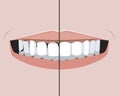 A teeth with caries and pulpitis and a healthy smile as a treatment concept in a dental or orthodontic clinic, a vector stock