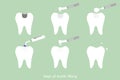 Step of caries to tooth amalgam filling with dental tools