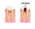 Teeth cavities