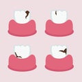 Teeth with cavities