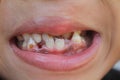 teeth in children cleft lip or cleft palate that is damaged