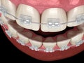 Teeth Clear braces. Medically accurate dental illustration