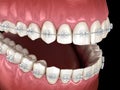 Teeth Clear braces. Medically accurate dental illustration