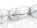 Teeth and Clear braces. Medically accurate dental 3D illustration