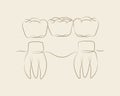 Teeth with crown bridge beige color