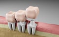 teeth crowns dental filling, Oral health and dental inspection teeth. Medical dentist tool, children healthcare, 3d render