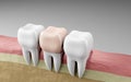teeth crowns dental filling, Oral health and dental inspection teeth. Medical dentist tool, children healthcare, 3D render