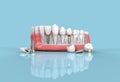 teeth dental implant model 3d illustration