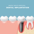 Teeth and dental implantat inserted into gum - tooth