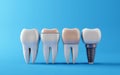teeth with different types of dental filling with Dental teeth implants, Oral health and dental inspection teeth. Medical dentist