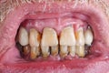 The teeth of an elderly man are spoiled by caries, tartar and po Royalty Free Stock Photo