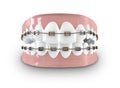 Teeth Fitted With Braces Royalty Free Stock Photo