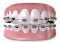 Teeth Fitted With Braces Close Royalty Free Stock Photo