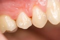 Teeth and gingivitis Royalty Free Stock Photo