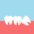 Teeth and gum problems. Impacted wisdom tooth for dentistry and dental surgery in flat style vector illustration