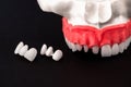 Teeth implant and crown installation process parts on a black background. Medically accurate 3D model.