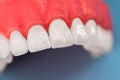 Teeth implant and crown installation process parts isolated on a blue background. Medically accurate 3D model.