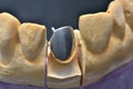 Teeth implant model details
