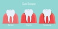 Teeth infographic Gum disease stages gingivitis